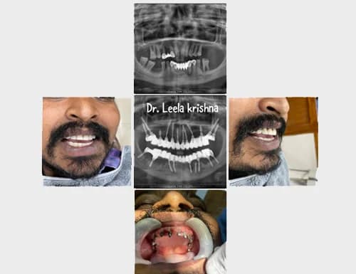 Full Mouth Basal Implant Rehabilitation & OPG