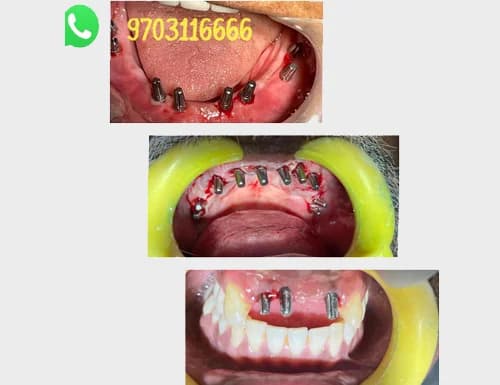 Same-Day Dental Implants