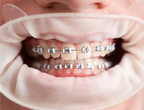 Aesthetic Tooth-Colored Ceramic Braces