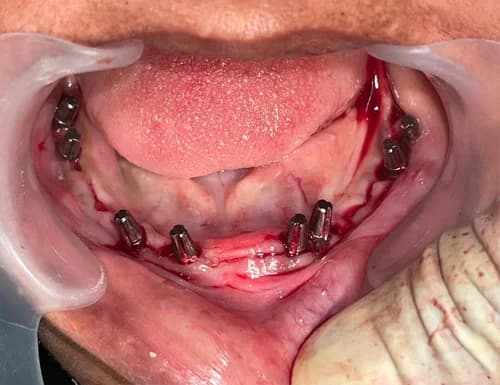 Mandibular Ridge Basal Implant Placement