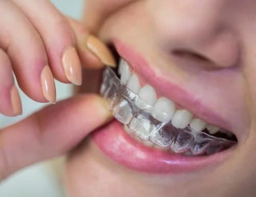 Clear Aligner Micro-Movement Tray Seating
