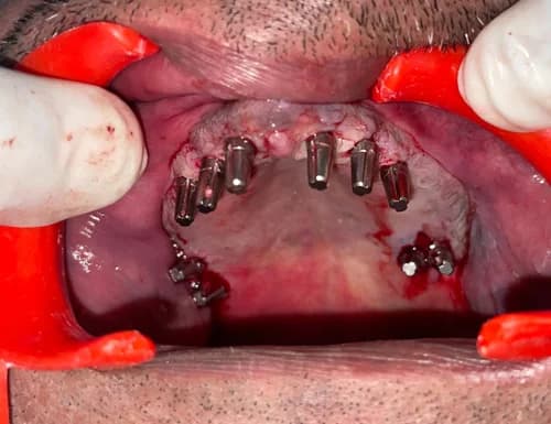 Maxillary Sinus Bypass Cortical Implant Fixation