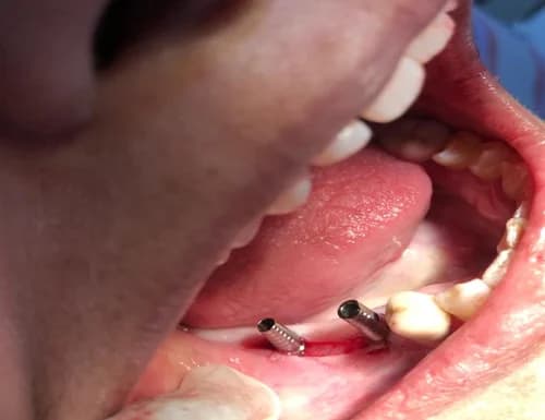 Conventional 2-Stage Dental Implants