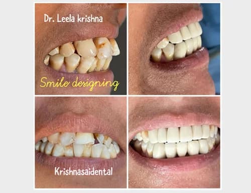 Comprehensive Smile Makeover & Aesthetic Contouring