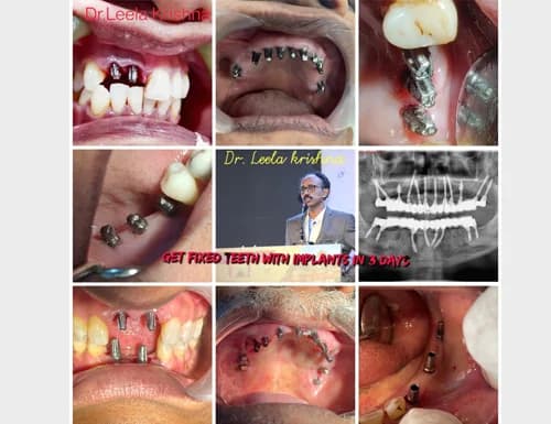 Fixed Teeth with Implants in 3 Days (Conference & Multi-Case)