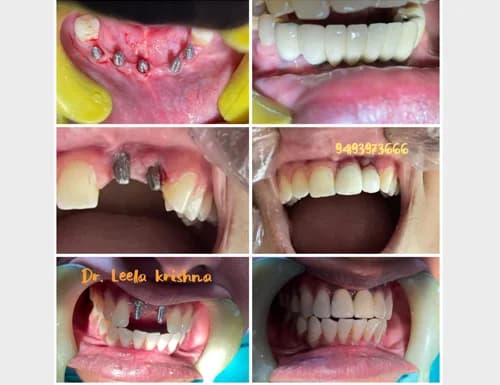 Multiple Anterior & Posterior Cortical Implant Placements
