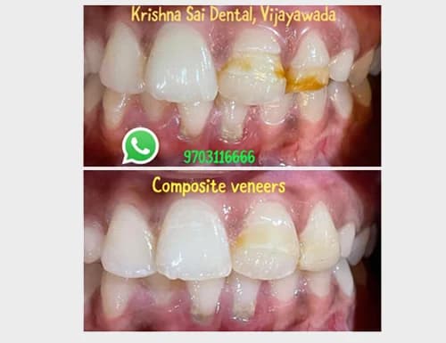 Composite Veneers for Fluorosis & Enamel Staining