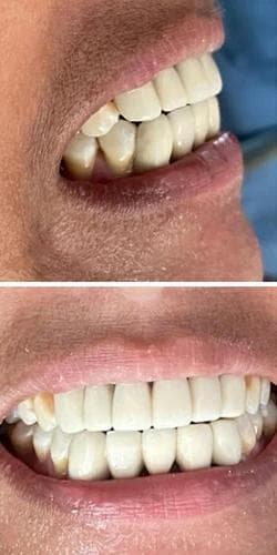 Direct Aesthetic Smile Designing & Alignment - After