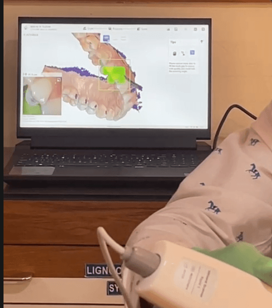 3D digital dental scan captured with intraoral optical scanner