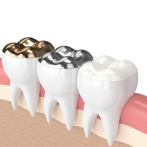 Monolithic Zirconia & Ceramic Crowns