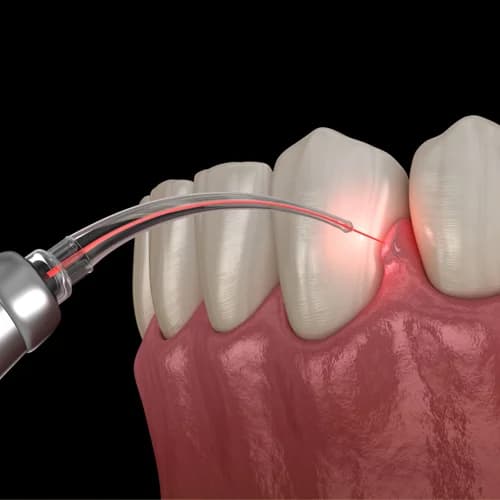 Soft Tissue Dental Laser Periodontal Therapy