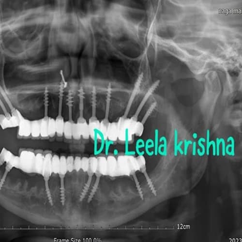 Panoramic OPG Full Mouth Implant X-Ray