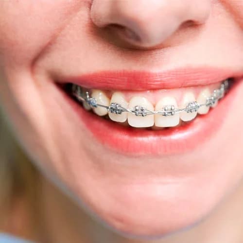 Ceramic & Self-Ligating Braces