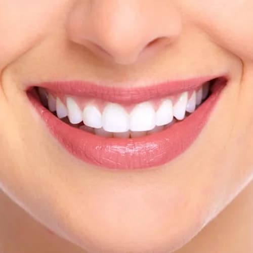 In-Office Laser Teeth Whitening