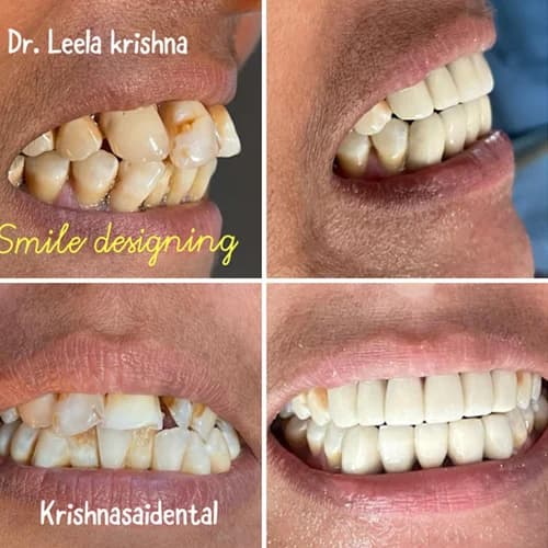Digital Smile Designing & Makeover