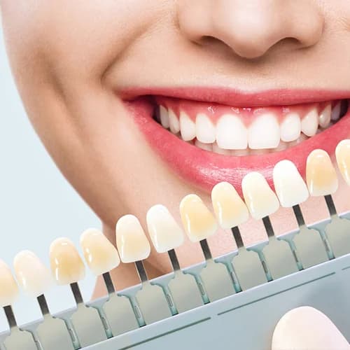Porcelain & Ceramic Veneers