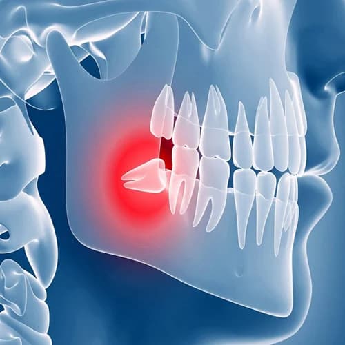 Horizontally Impacted Wisdom Tooth Diagnostic View